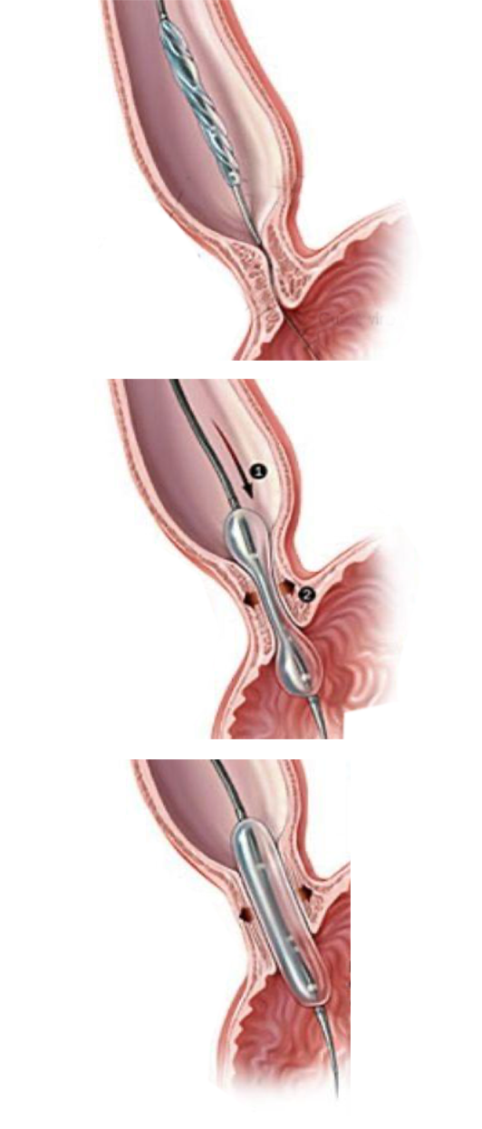 dilatacion