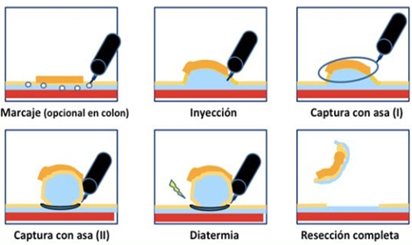 mucosectomiaa