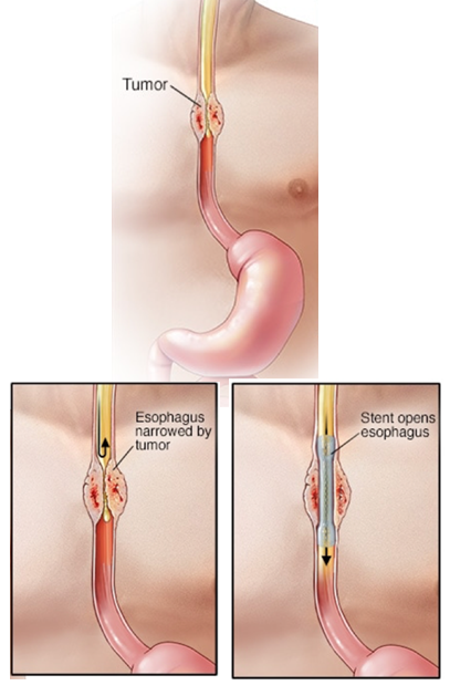 stent